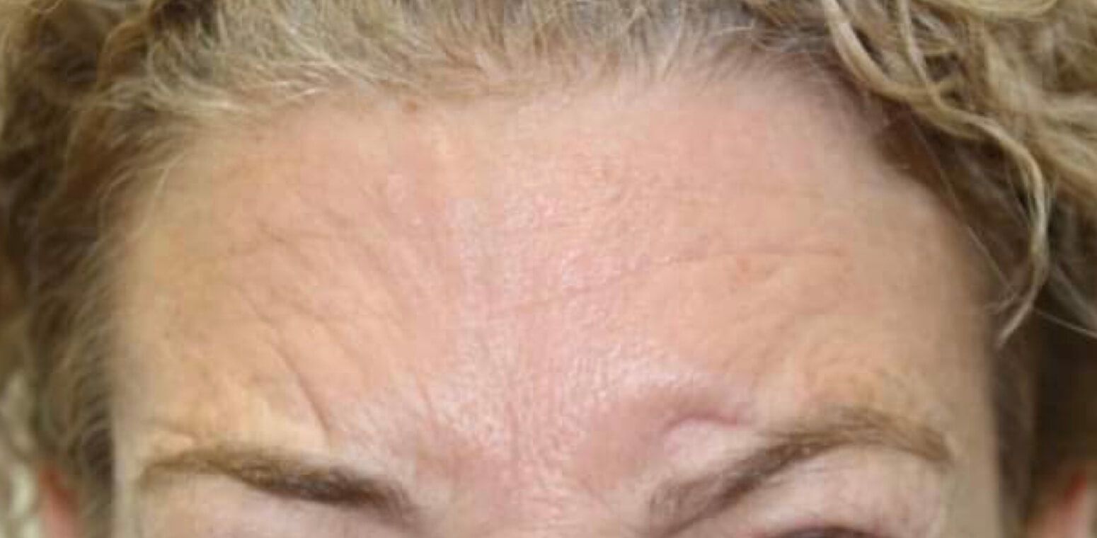 A close up of a woman 's forehead with wrinkles.