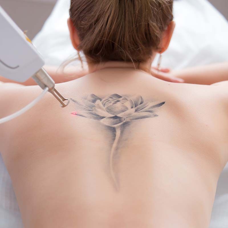 A woman is getting a tattoo removed from her back.