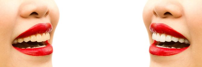 Skin Care Clinic West Hoxton | teeth Whitening