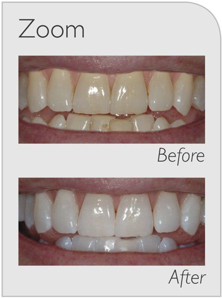 before and after teeth treatment