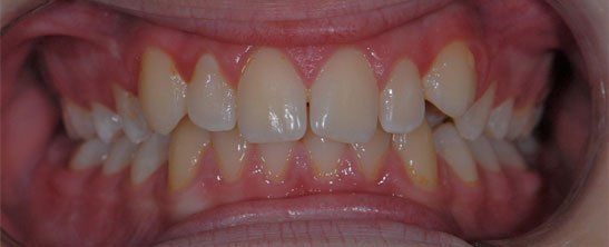 Orthodontics before braces
