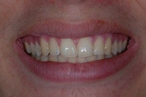 teeth after braces