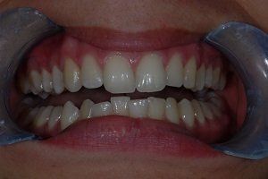 teeth before braces