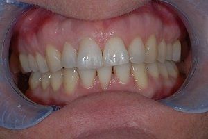 mouth after braces