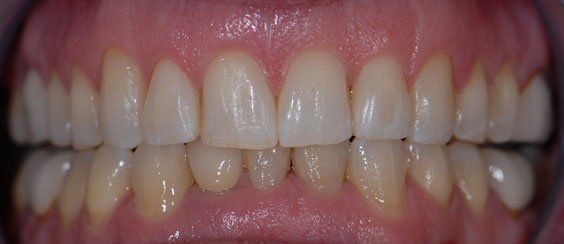 Teeth smile after Invisalign
