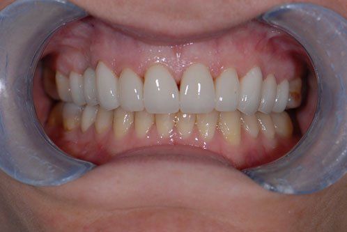 Teeth After Crowns