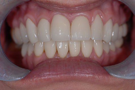 Teeth After Crowns