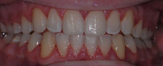 Orthodontics after braces