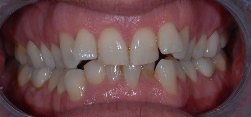 Teeth before Invisalign