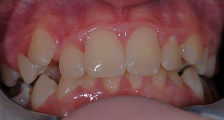 Orthodontics before braces