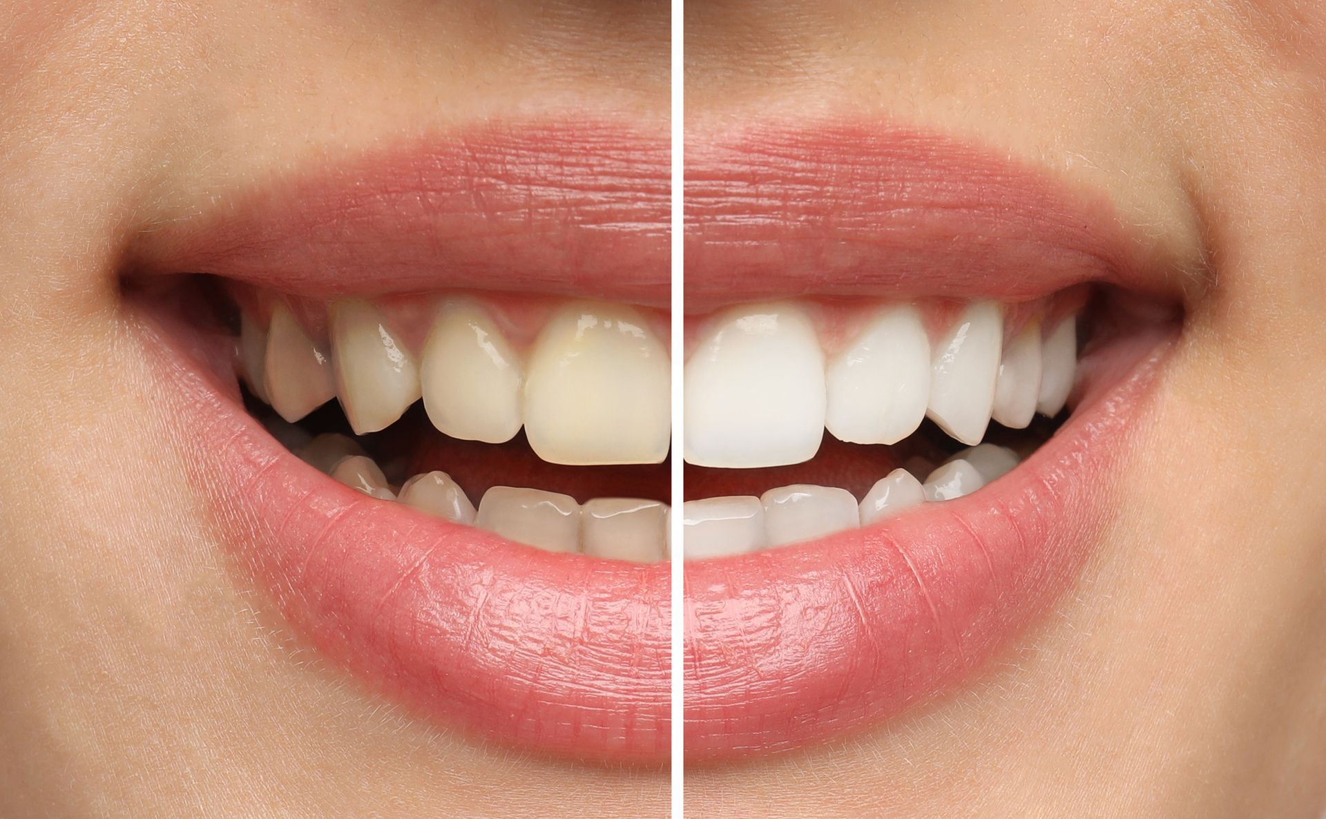 Close-up of teeth showing before and after whitening comparison split down middle. Close-up of teeth showing before and after whitening comparison split down middle.