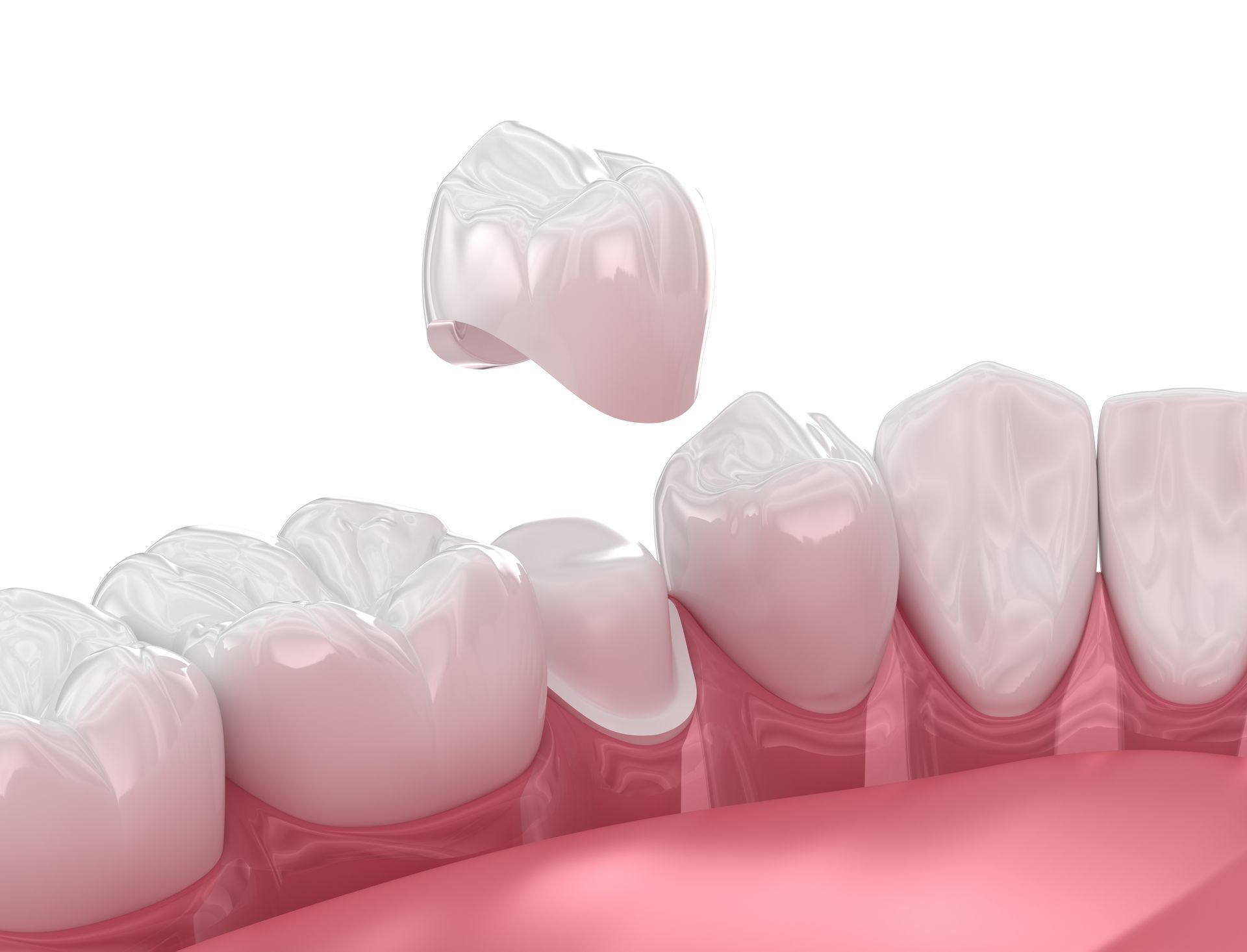 3D illustration of dental crown placement over tooth. 3D illustration of dental crown placement over tooth.
