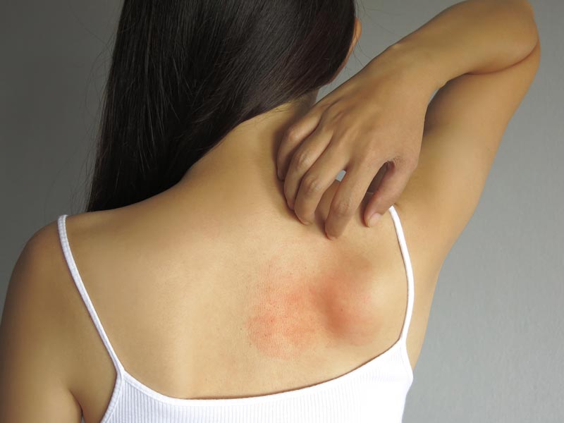 woman with a back rash
