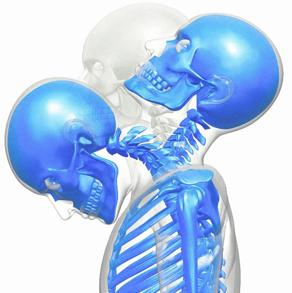 Illustration of the human skull and spine in blue, depicting a head impact with varying degrees of motion.