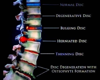 Diagram showing a spinal column with labels for different types of disc problems, including normal, degenerative, bulging, herniated, thinning, and degeneration with osteophyte formation.