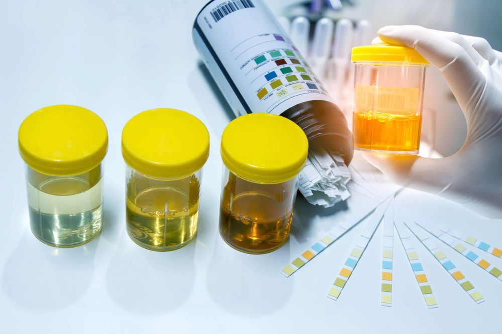 Urine samples in yellow-capped containers with color chart and testing strips; hand in glove holds sample — DAB Services in Bendigo, QLD