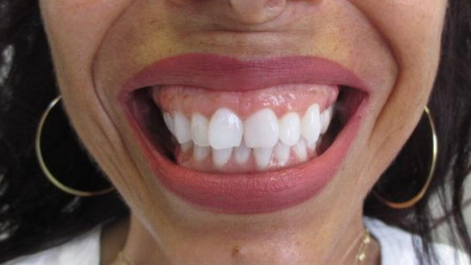 Botox Before Photo-The Smile and Face Company-Savannah, GA