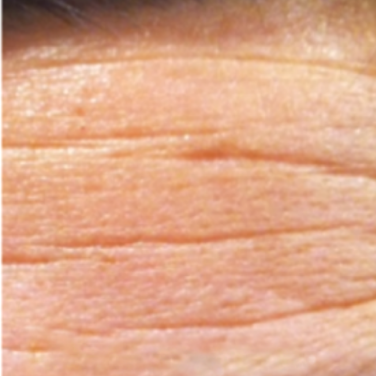 Botox on Wrinkles Before-The Smile and Face Company-Savannah, GA