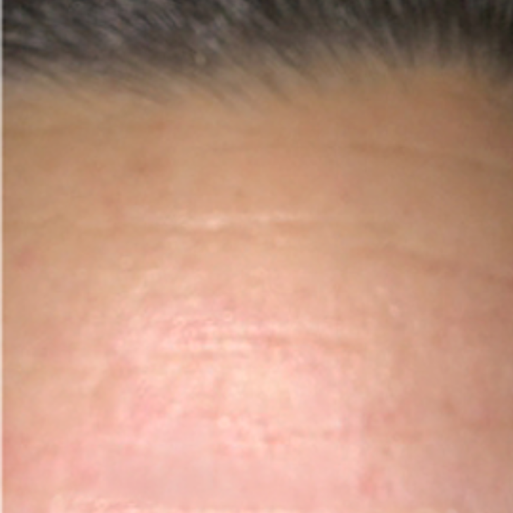 Botox on Wrinkles After Photo-The Smile and Face Company-Savannah, GA