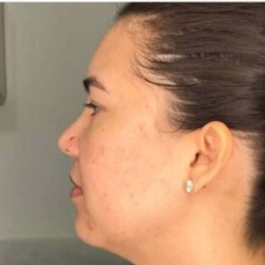 PRF Acne Treatment After-The Smile and Face Company-Savannah, GA