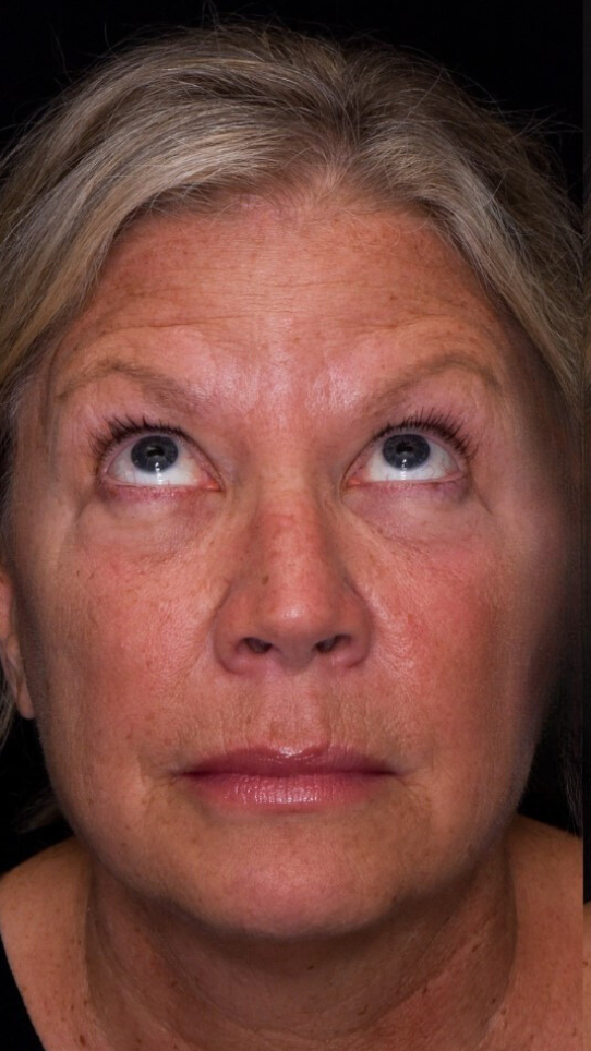 Facial Injection PRF Treatment Before Photo-The Smile and Face Company-Savannah, GA