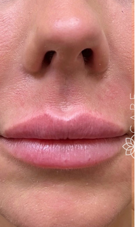 Dermal Lip Fillers Before Photo-The Smile and Face Company-Savannah, GA