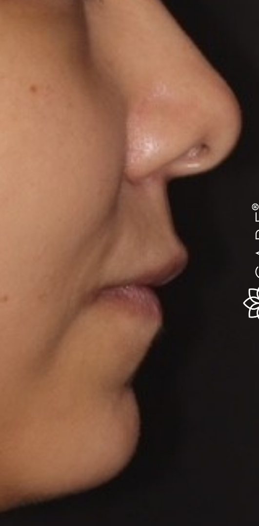 Profile of Lip Augmentation Before-The Smile and Face Company-Savannah, GA