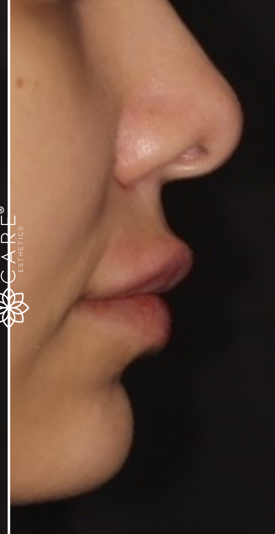 Profile of Lip Fillers After-The Smile and Face Company-Savannah, GA