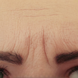 Eyebrow Wrinkles Treatment Before-The Smile and Face Company-Savannah, GA