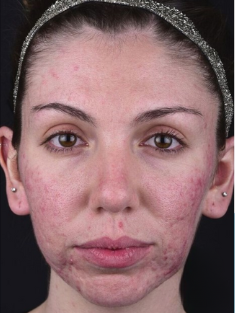 Acne Scarring-The Smile and Face Company-Savannah, GA