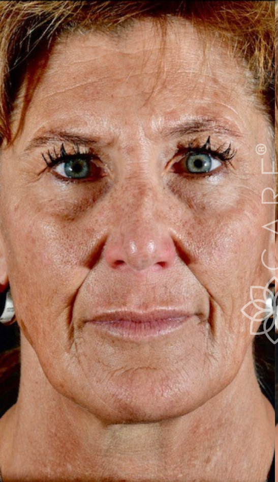 Botox Facial Treatment Before-The Smile and Face Company-Savannah, GA