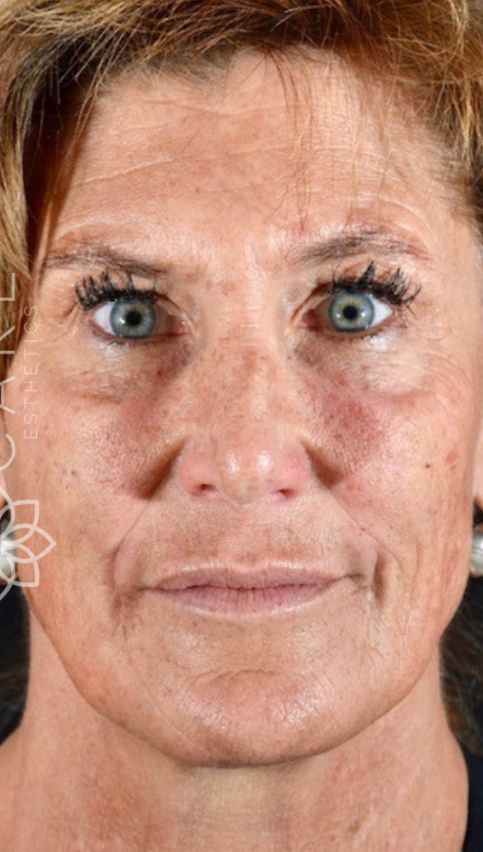 Botox Facial Treatment After-The Smile and Face Company-Savannah, GA