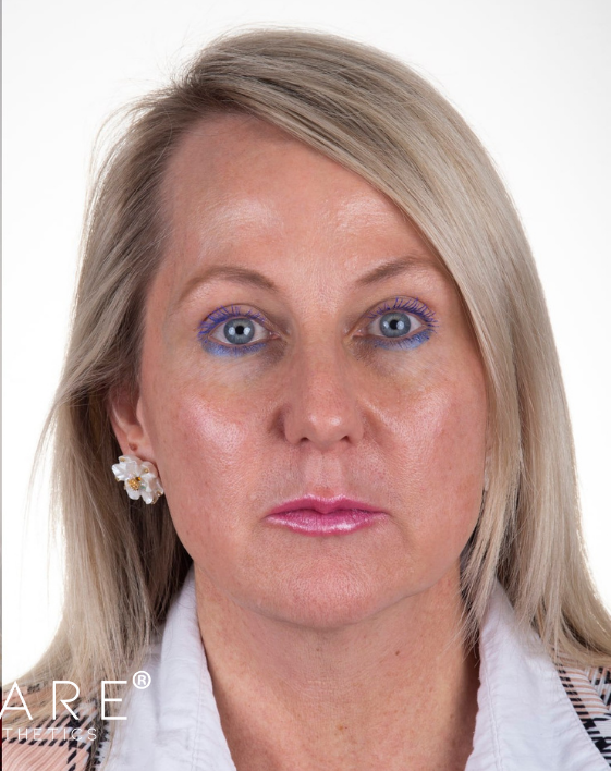 Dermal Fillers After Photo-The Smile and Face Company-Savannah, GA