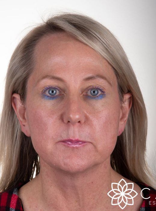 Dermal Fillers Before Photo-The Smile and Face Company-Savannah, GA