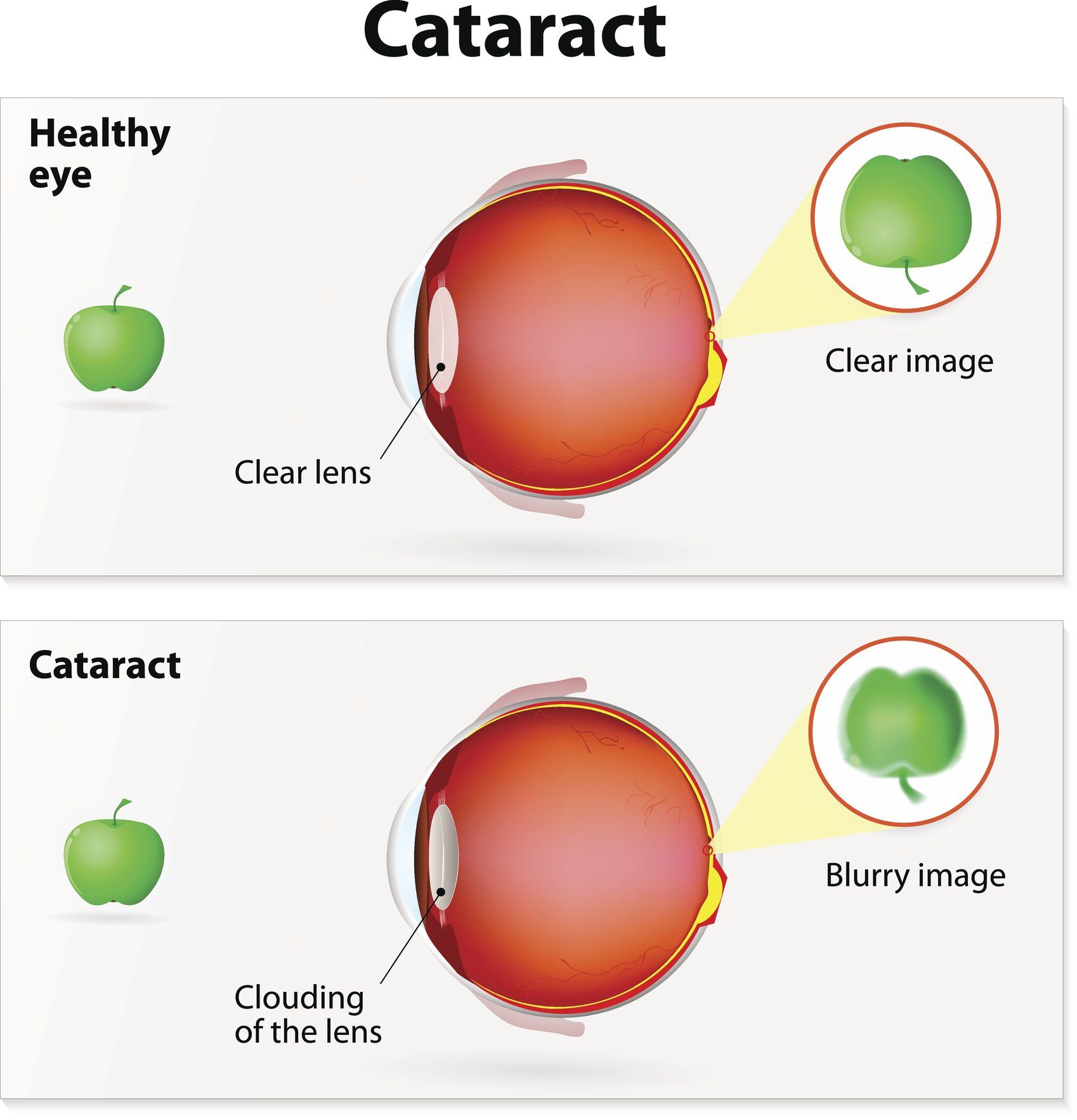 Cataract