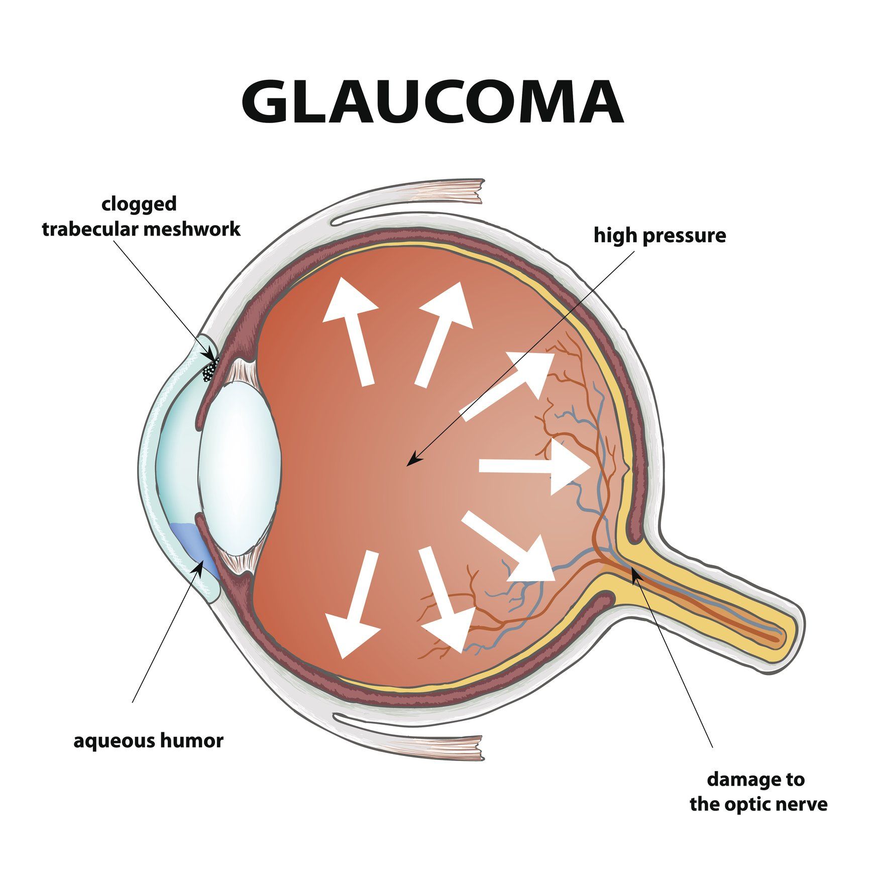 Glaucoma