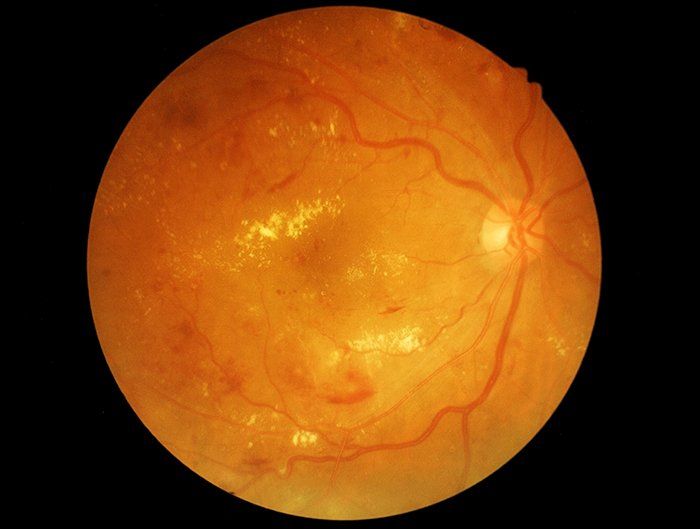 Diabetic Retinopathy