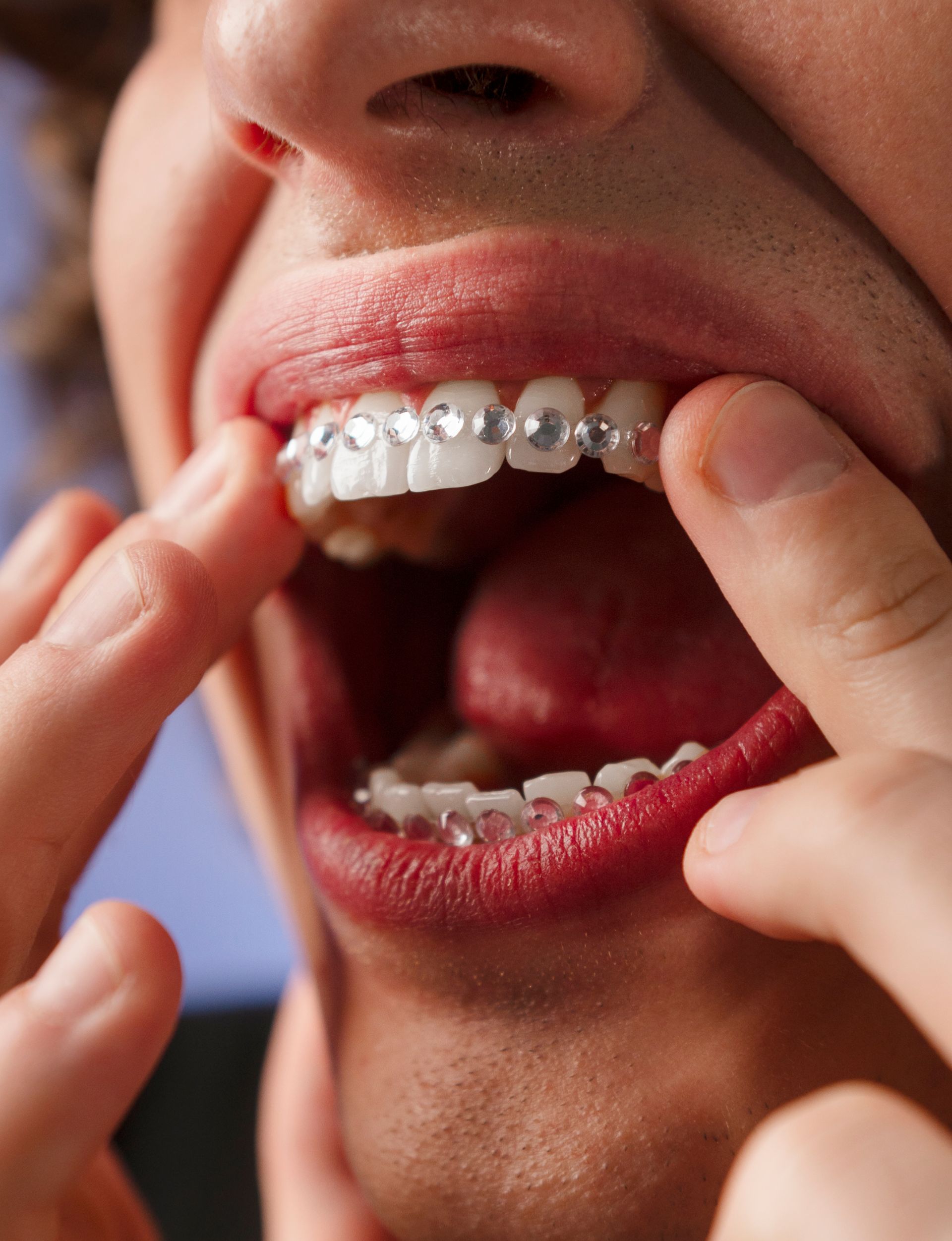 A close up of a person with braces on their teeth