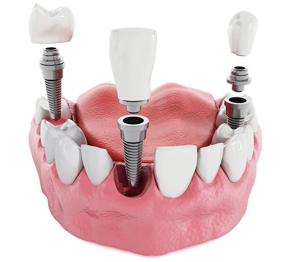 Dental Implants in Manteca, CA