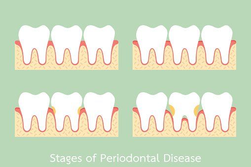 Surgery — Stages Of Periodontal Disease in MILWAUKEE, WI