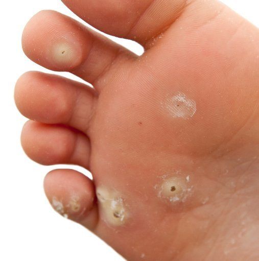 craig boulton podiatry plantar warts