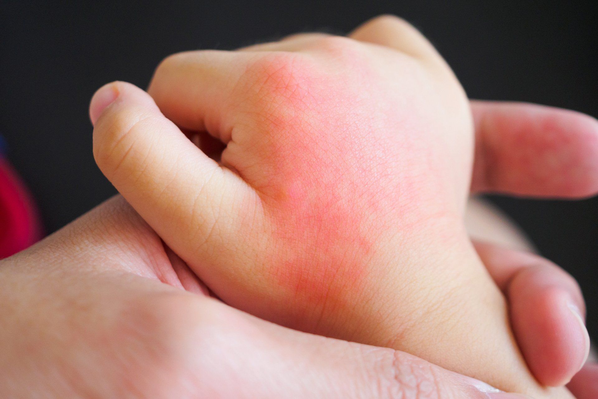 A person is holding a child 's hand with red spots on it.