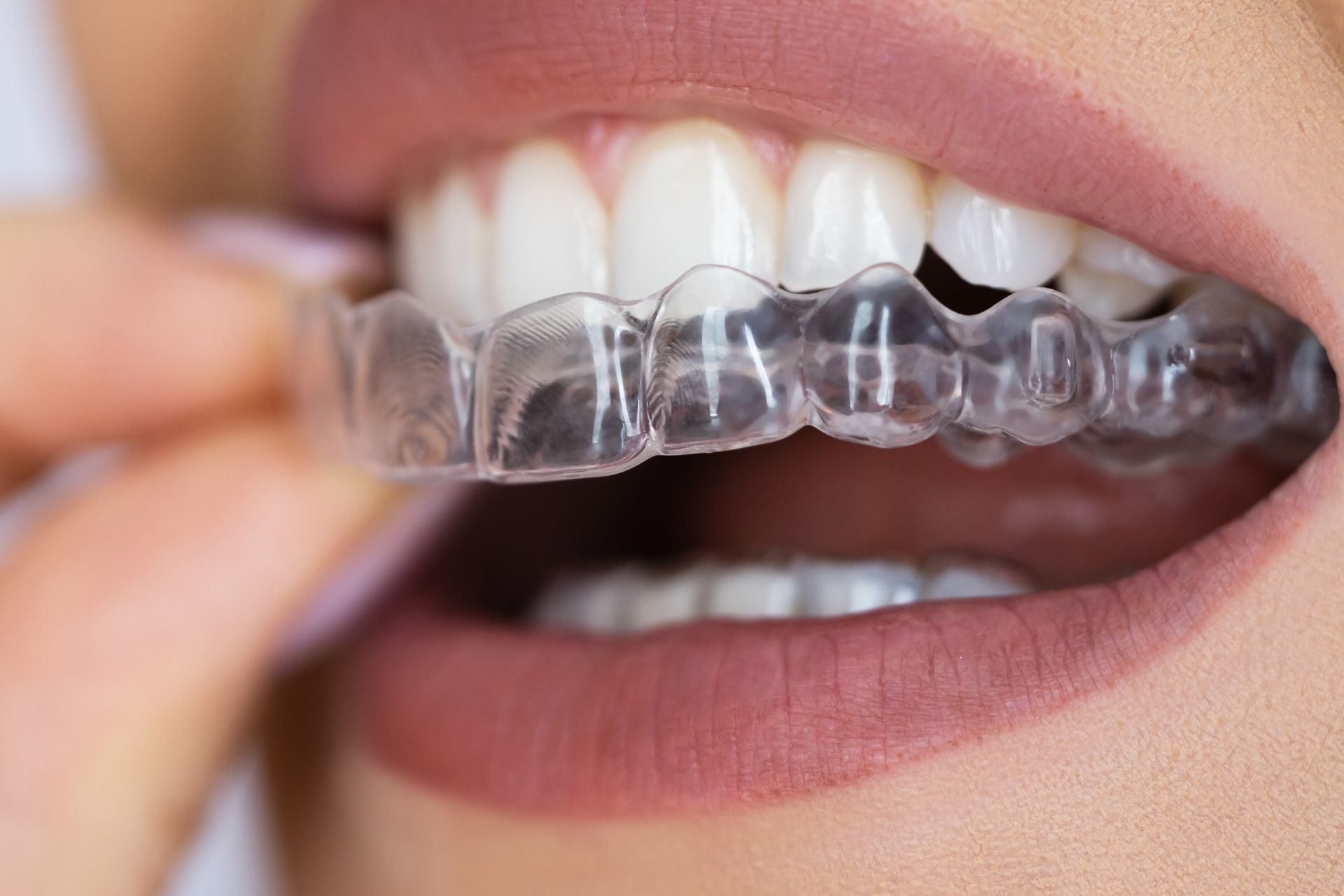 A woman is putting a clear brace on her teeth.