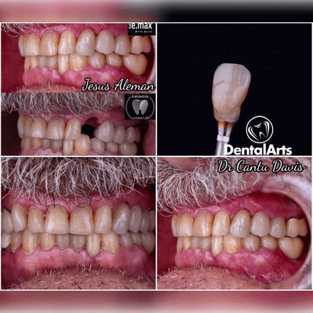 Implantes dentales