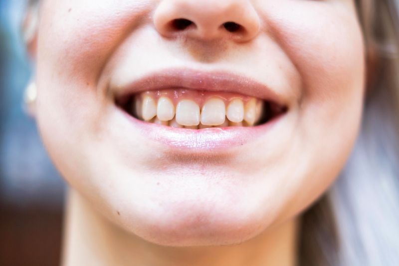 Smiling Teeth — Ventura, CA — Surfside Dental