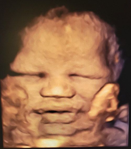 8th Month Baby Ultrasound — Middletown, NY — LAFS Ultrasound