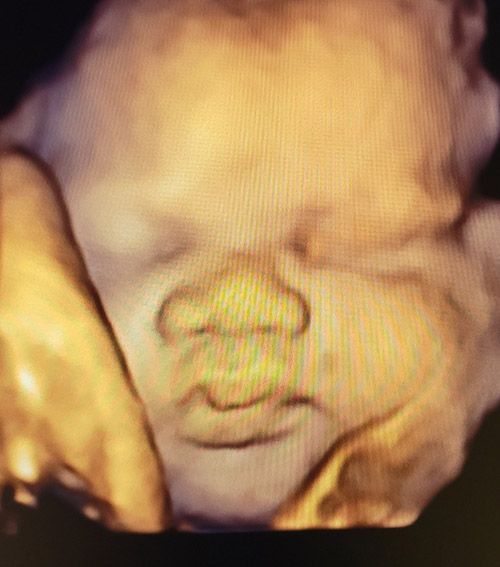 7th Month Baby Ultrasound — Middletown, NY — LAFS Ultrasound