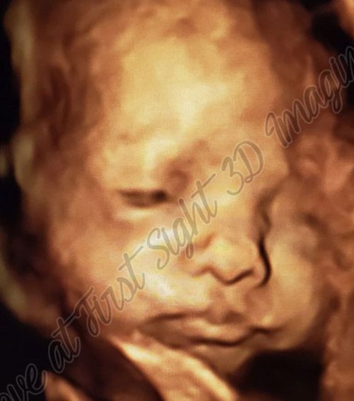 5th Month Baby Ultrasound — Middletown, NY — LAFS Ultrasound