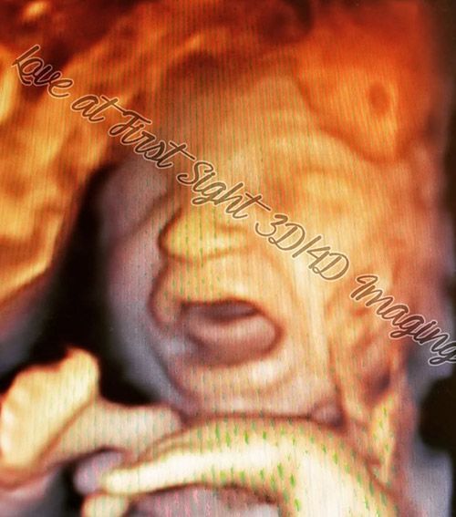 2nd Month Baby Ultrasound — Middletown, NY — LAFS Ultrasound