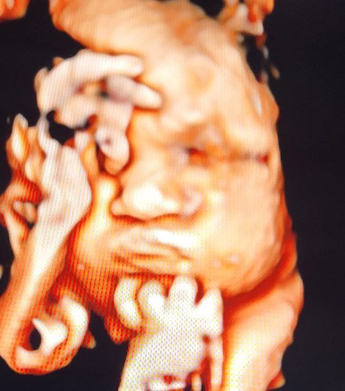 6th Month Baby Ultrasound — Middletown, NY — LAFS Ultrasound